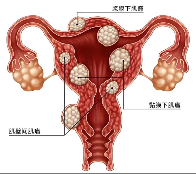 泰安俪人医院子宫肌瘤.jpg